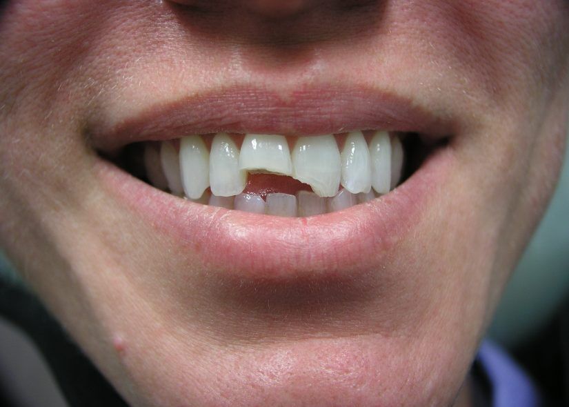 Broken front teeth fixed with crowns (before)