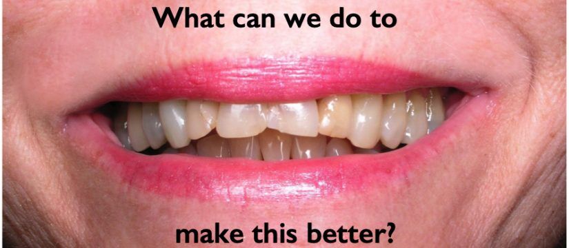 Smile enhanced with crowns and a bridge